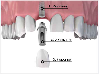 protezirovanie_zubov_na_implantatah