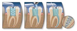 endo-root-canal-steps
